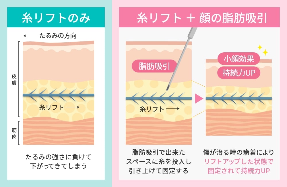 顔の脂肪吸引と糸リフトの相乗効果