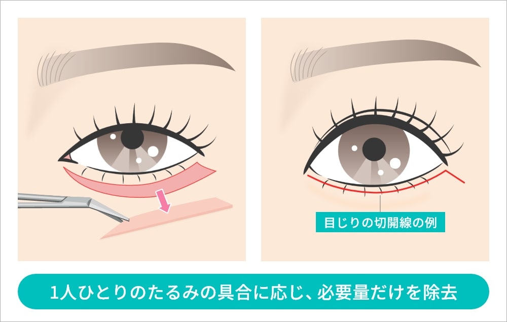 目の下の余剰皮膚を切除する