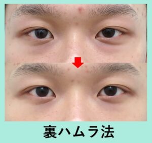 裏ハムラ法の症例写真　男性