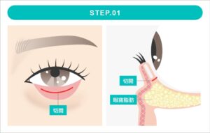 裏ハムラ法の施術　STEP1