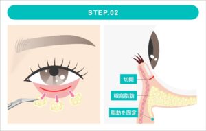 裏ハムラ法の施術　STEP2