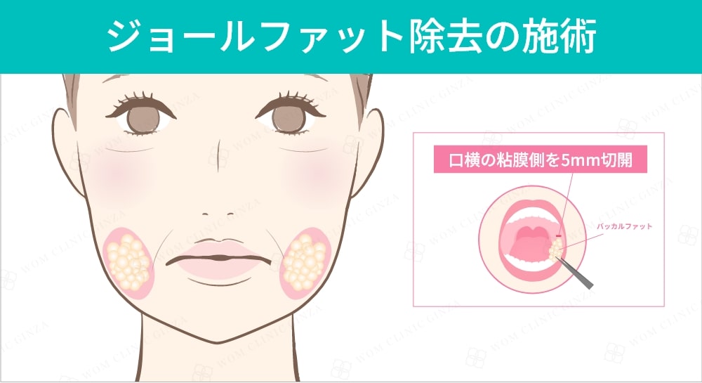 ジョールファット除去の施術
