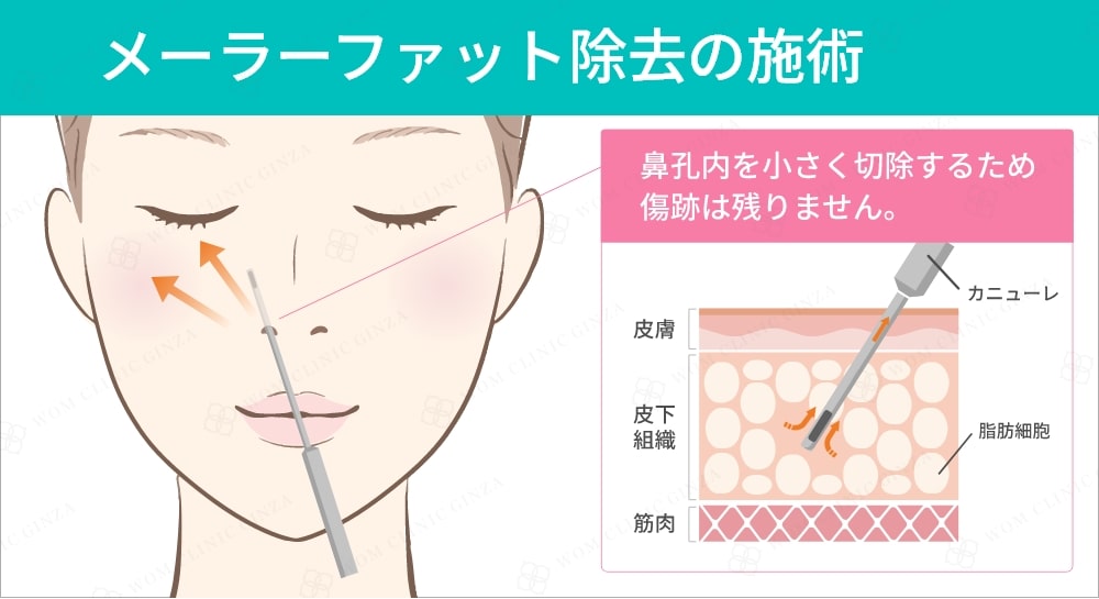 メーラーファット除去の施術