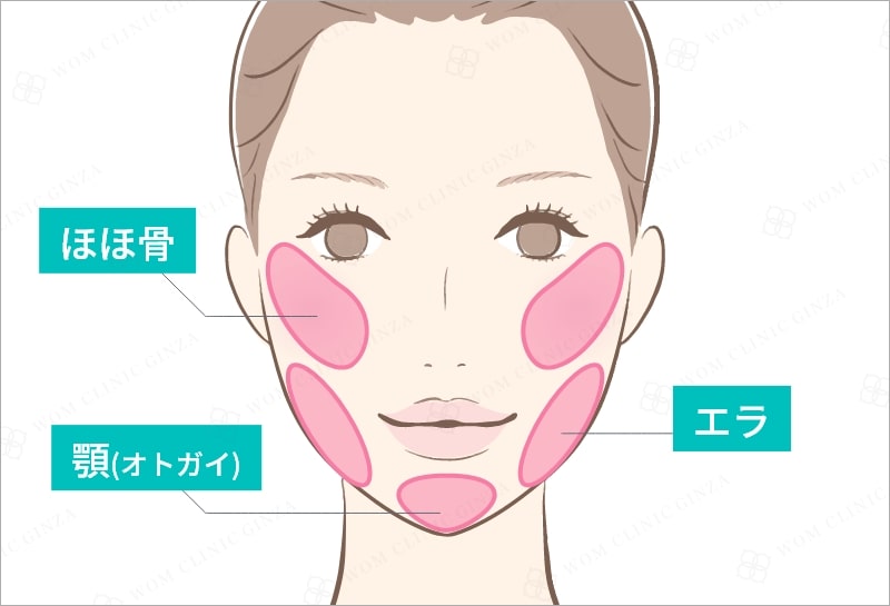 切る小顔整形の説明図
