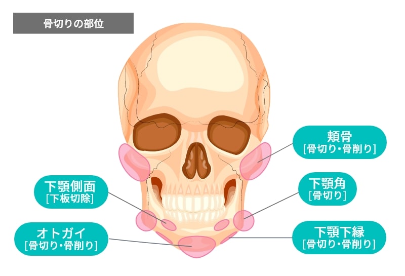 骨切り施術の説明図