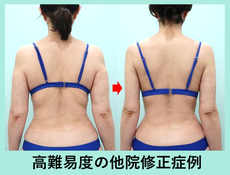 背中と腰の脂肪吸引前後比較