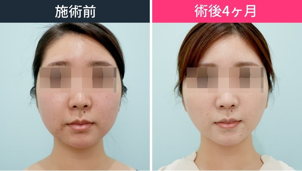 施術前後女性の顔比較