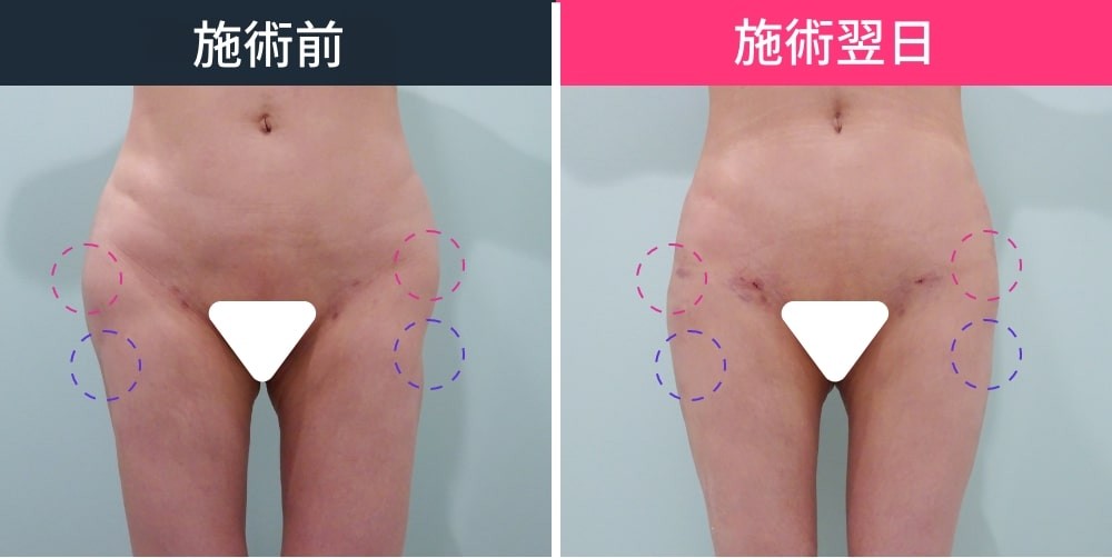 女性の施術前と施術翌日の腹部と太もも