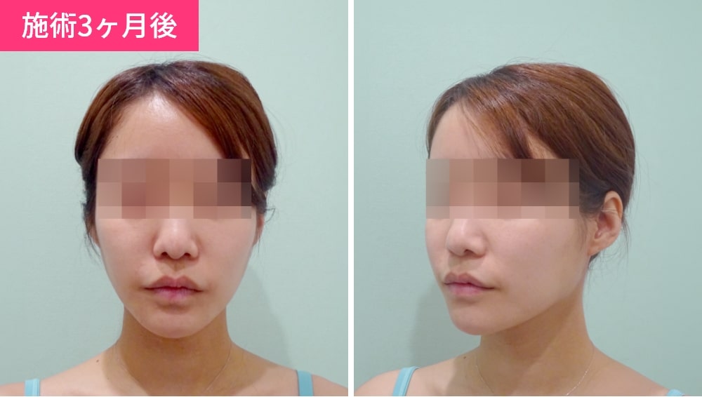 顔の脂肪吸引の症例写真3ヶ月後