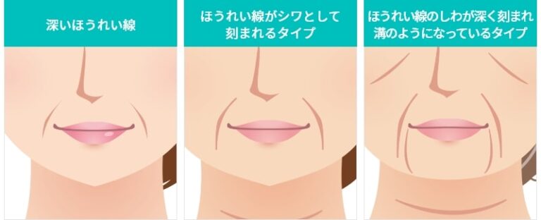 笑ったときのほうれい線を見違えるほど改善！おすすめの解決方法を紹介 Womクリニック銀座