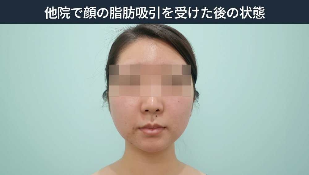 他院で顔の脂肪吸引を受けた後の状態の症例写真