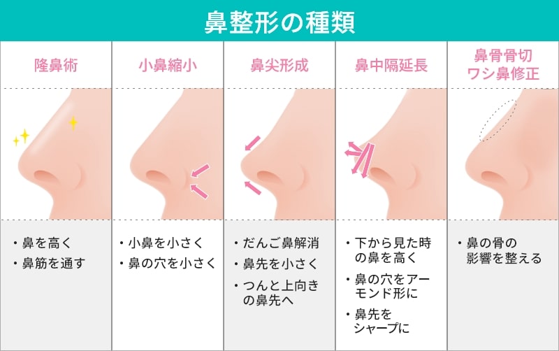 鼻整形の種類の説明図