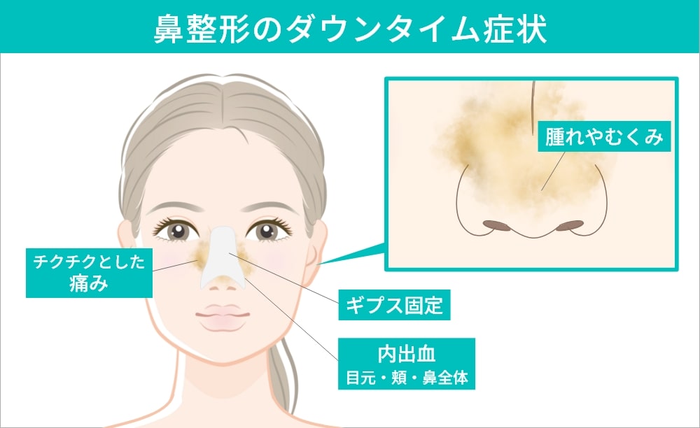鼻尖形成のダウンタイム