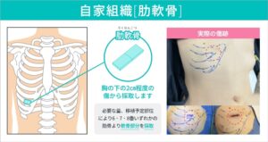 自家組織