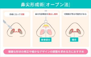 鼻尖形成　オープン法の説明図