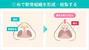 鼻尖形成　手術方法①