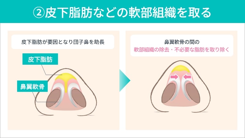 鼻尖形成術 - 東京・銀座の美容外科クリニック|WOM CLINIC GINZA
