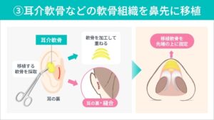 鼻尖形成　手術方法③