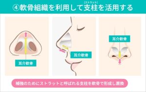 鼻尖形成　手術方法④