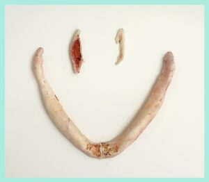 オトガイ形成で切除した骨