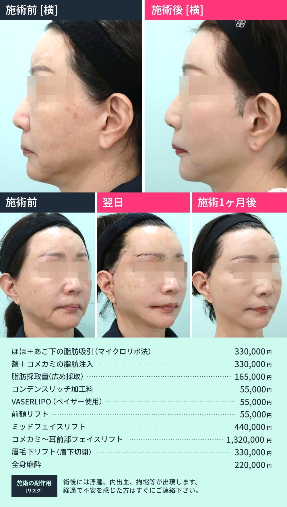 フェイスリフト - 東京・銀座の美容外科クリニック｜WOM CLINIC GINZA