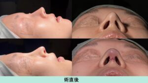 異物除去の症例写真02（下）