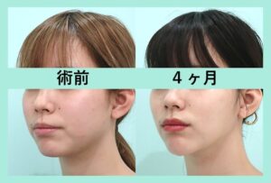 ヒアルロン酸注入の症例写真