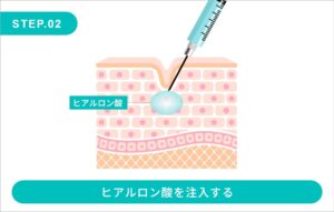ヒアルロン酸注入ステップ02