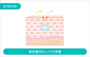 ヒアルロン酸注入ステップ03