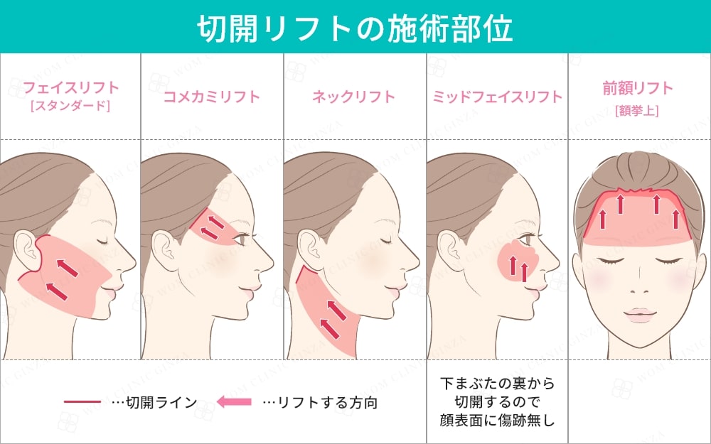 切開リフトの施術部位