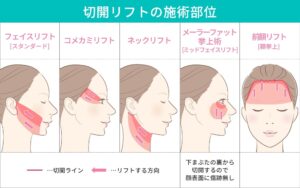 切開リフトの施術部位