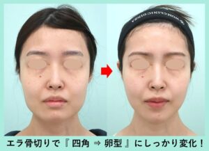 エラ骨切りの症例写真（正面）
