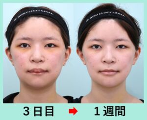 韓国式輪郭3点 術後1週間の症例写真