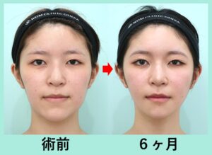韓国式輪郭3点の症例写真