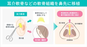 鼻中隔延長で使用される軟骨（耳介軟骨など）