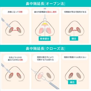 施術方法（オープン法・クローズ法）