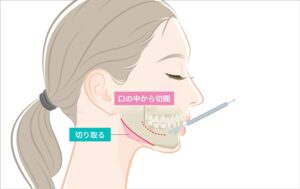 エラ骨切りの切開部分