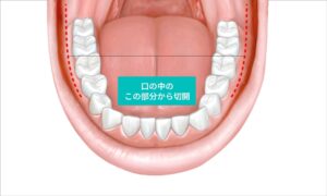 口腔内の切開部分
