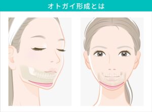 オトガイ形成とは