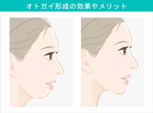 オトガイ形成によるメリット