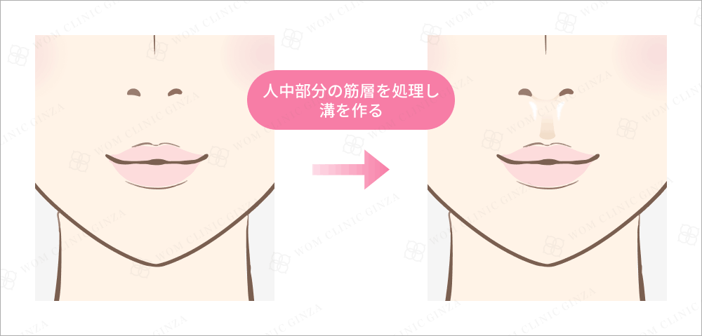 人中窩形成