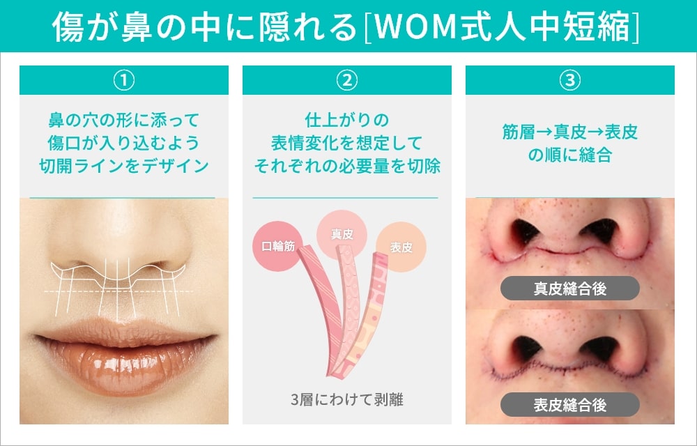 WOW式人中短縮