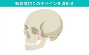 頬骨骨切り（縮小）のデザイン01