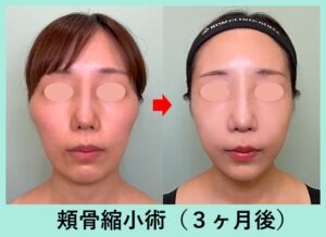 頬骨縮小骨切り（頬骨縮小）の症例写真02（正面）