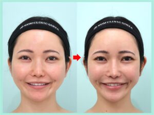 頬骨骨切り（頬骨縮小）の症例写真（正面）