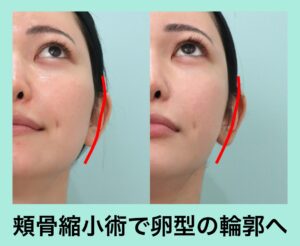 頬骨骨切り（頬骨縮小）の症例写真（横）
