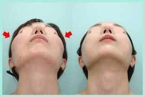 頬骨縮小骨切り（頬骨縮小）の症例写真02（下）