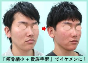頬骨縮小骨切り（頬骨縮小）＋貴族手術の症例写真