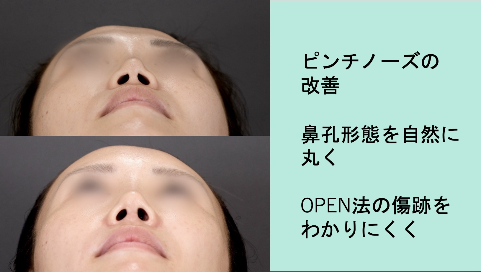 綺麗な鼻腔 他院修正 ピンチノーズを改善させ綺麗な鼻に - WOMクリニック銀座