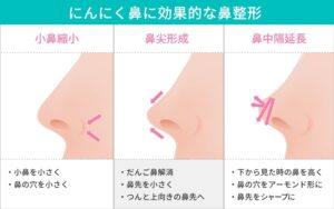 にんにく鼻に効果的な美容整形